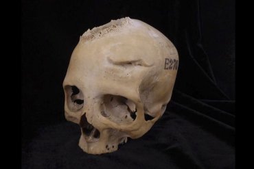 cancro antico egitto