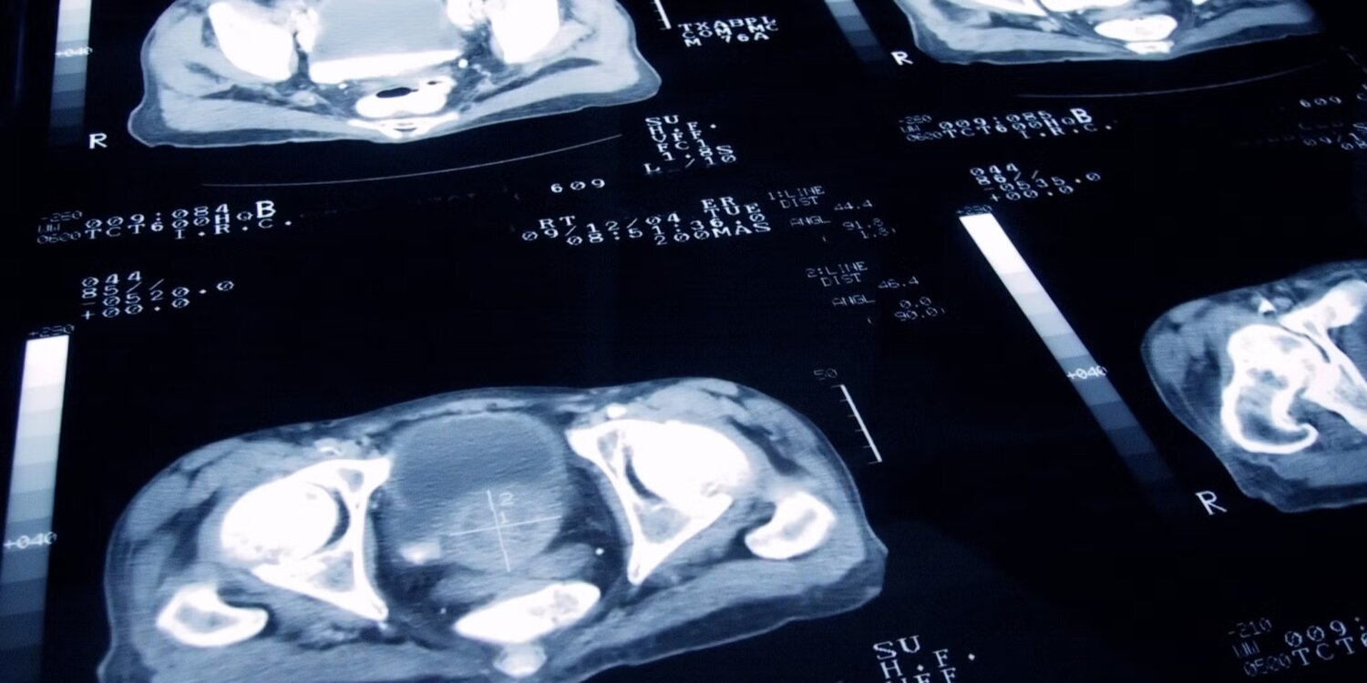 cura cancro ultra suoni